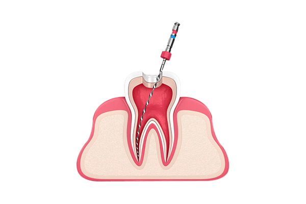 https://myhamptondental.com/wp-content/uploads/2022/01/Endodontics.png